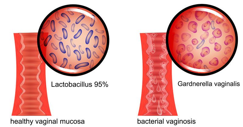Gardnerella Vaginalis